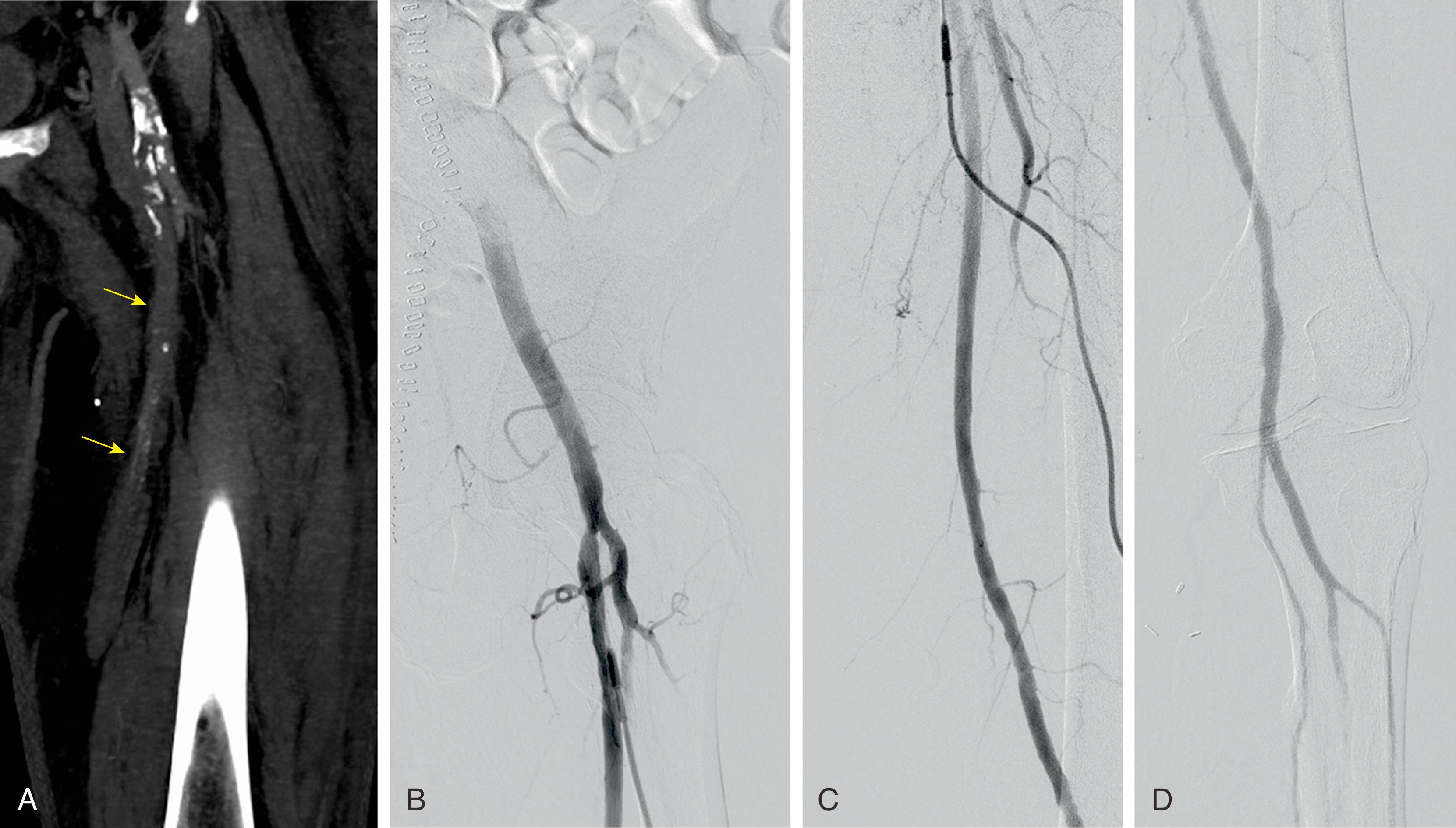 Figure 104.1, Preoperative CTA ( A ) demonstrating thrombosis of left superficial femoral artery (SFA) and popliteal artery ( yellow arrows ). Post-thrombectomy angiogram ( B–D ) showing patency from femoral to popliteal bifurcations.