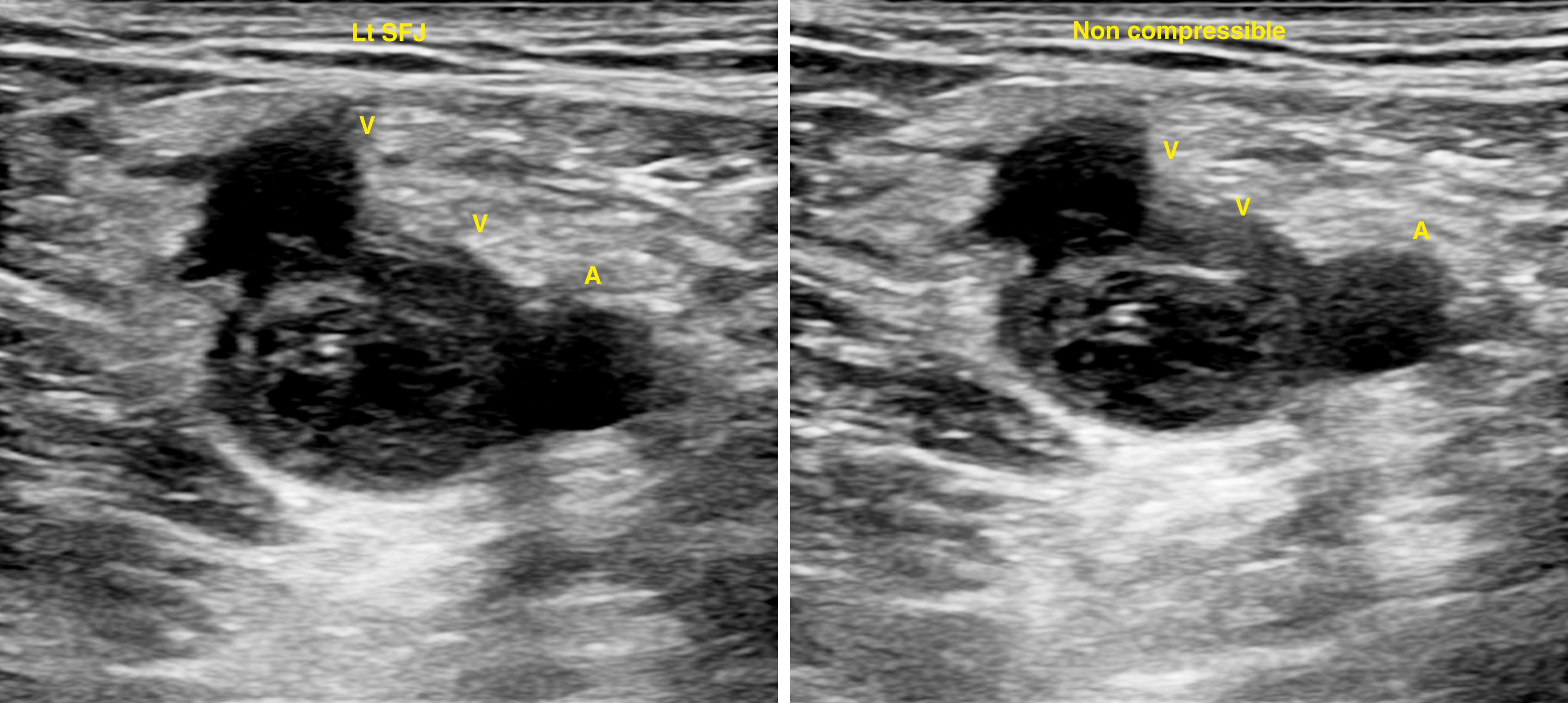 Figure 148.1, Totally Occluding, Acute Common Femoral Vein (CFV) Thrombosis.