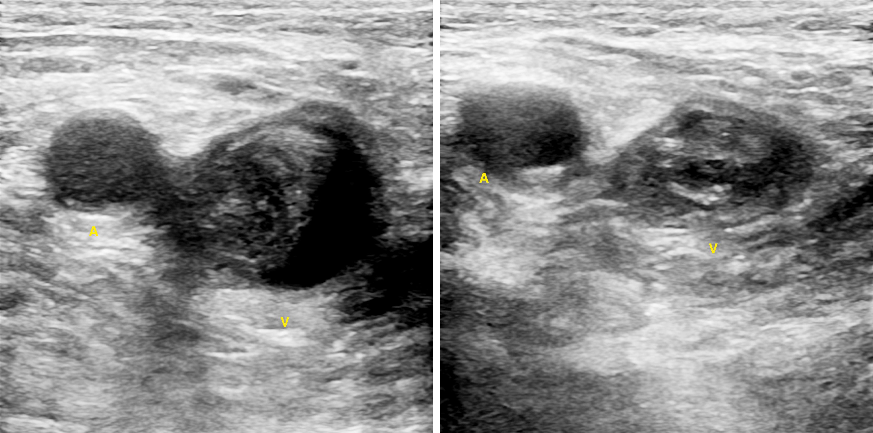 Figure 148.2, Age-Indeterminate Thrombus in the Femoral Vein.