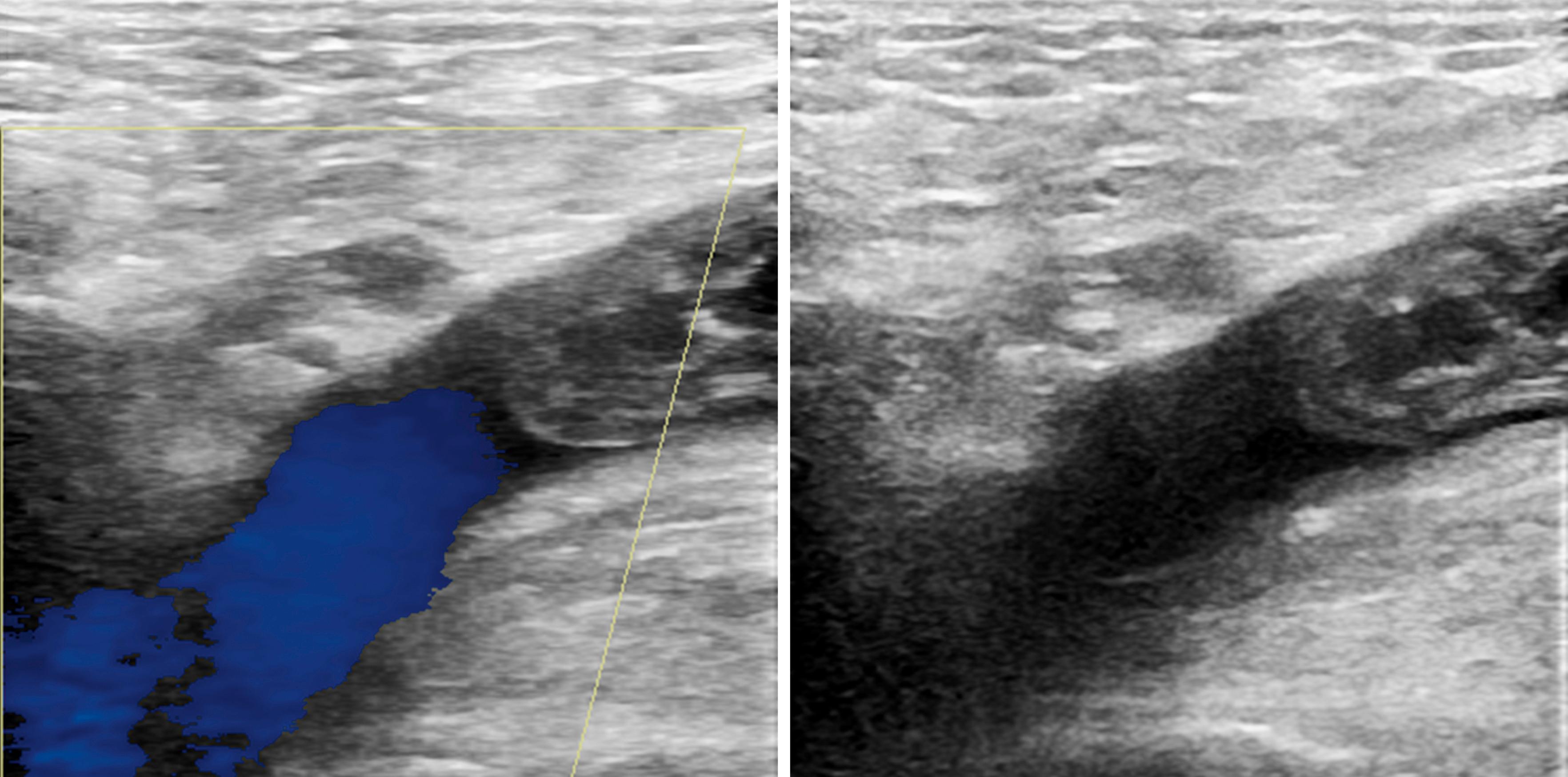 Figure 148.3, Thrombus in the Common Femoral Vein Extending into the External Iliac Vein.