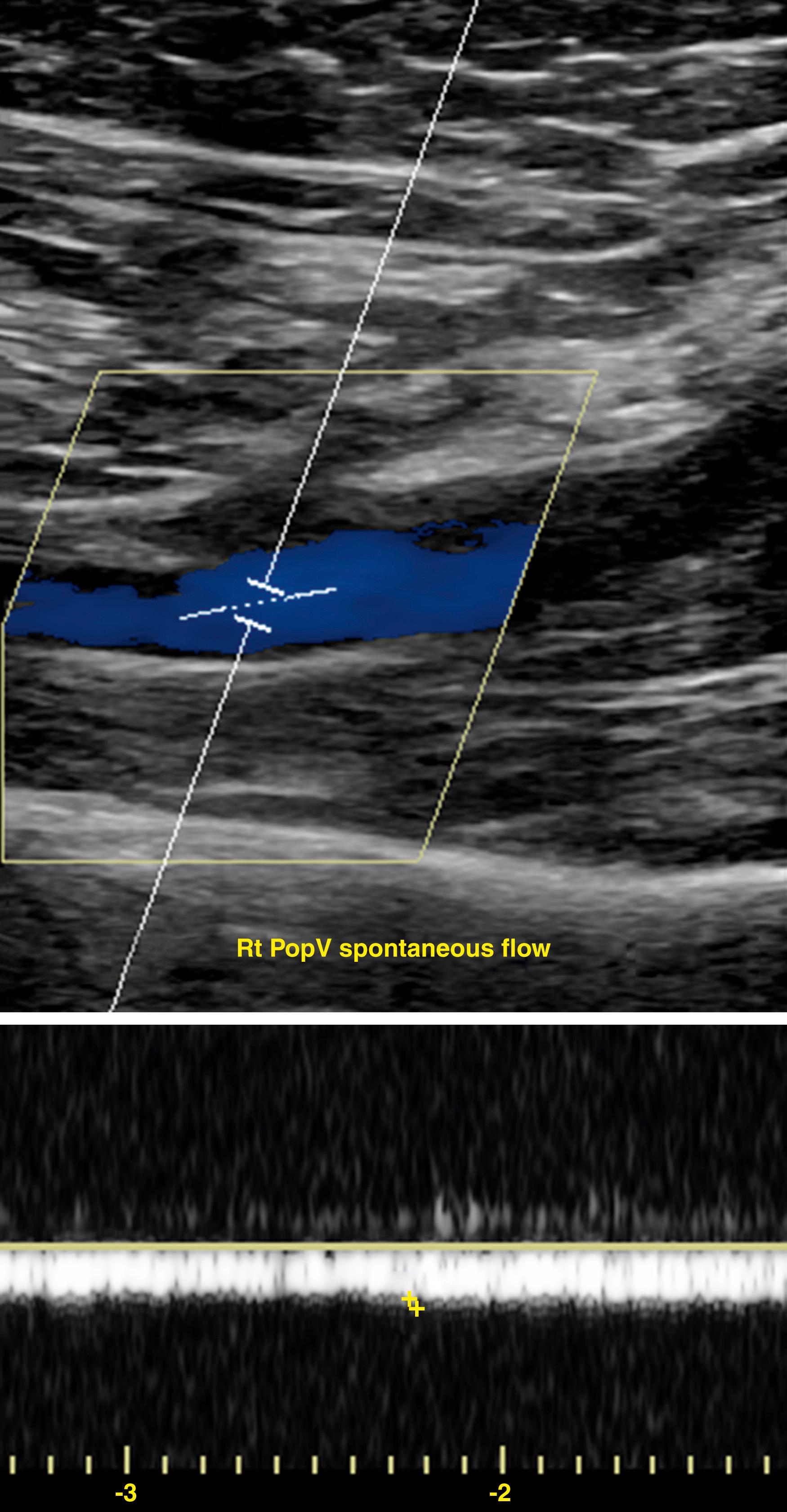 Figure 148.4, Duplex ultrasound image of popliteal vein in extremity with acute femoral–popliteal venous thrombosis during spontaneous flow. Color Doppler indicates the presence of the flow in the popliteal vein. The spectral Doppler demonstrates low-velocity continuous flow with lost phasicity (respiratory and cardiac) indicating more proximal obstruction.
