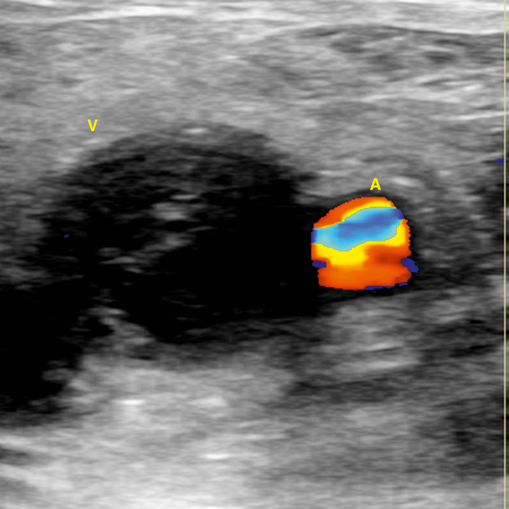 Figure 148.5, Duplex Ultrasound Image of Acute Thrombosis of the Common Femoral Vein (CFV).