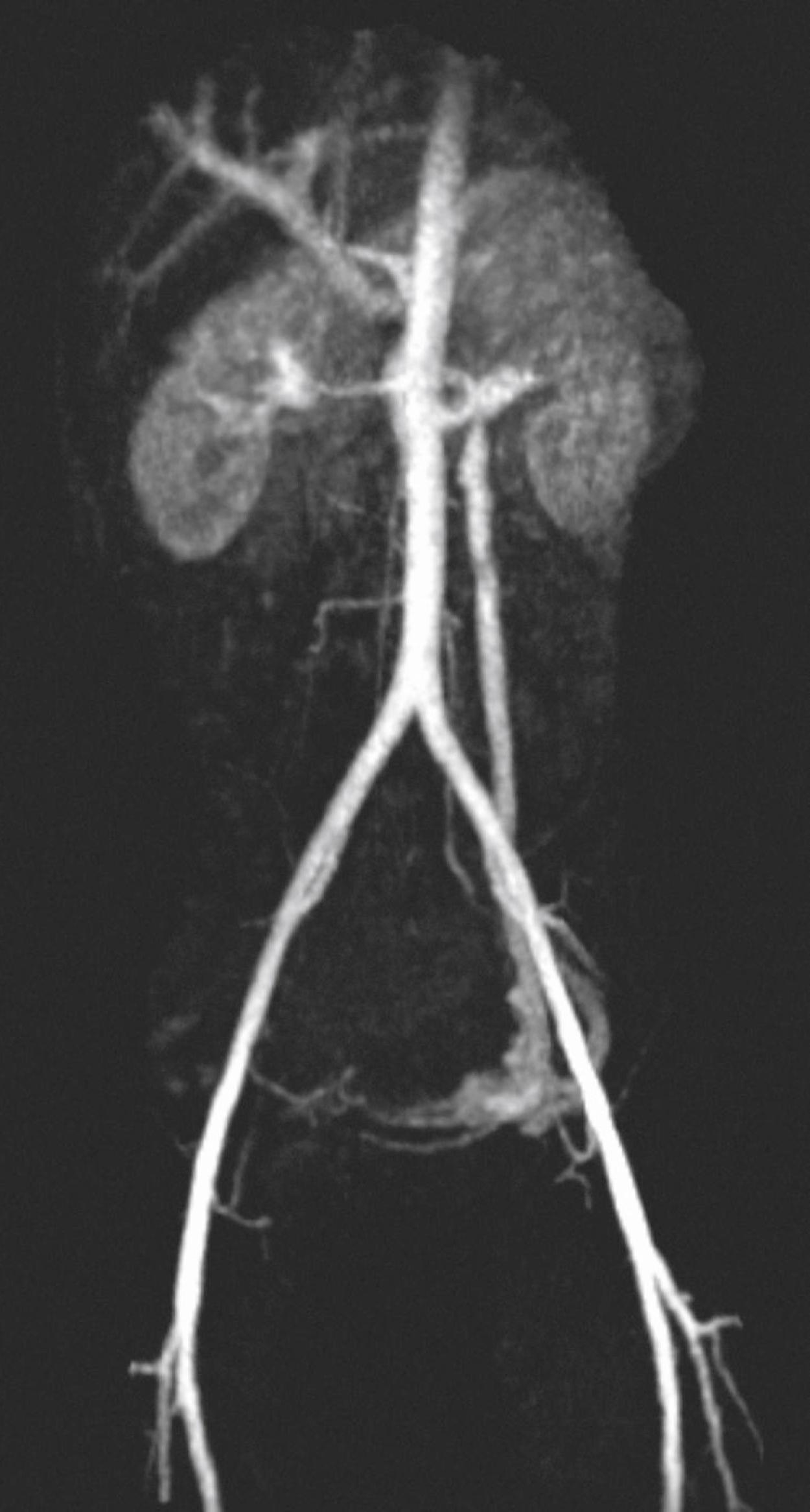 Figure 148.6, Time-resolved magnetic resonance imaging after intravenous administration of a long-acting contrast agent in a female patient with symptoms consistent with pelvic congestion syndrome. The image shows early reflux through the left ovarian vein into pelvic varices. The patient also has compression of the left renal vein between the superior mesenteric artery and aorta, consistent with the “nutcracker syndrome.”