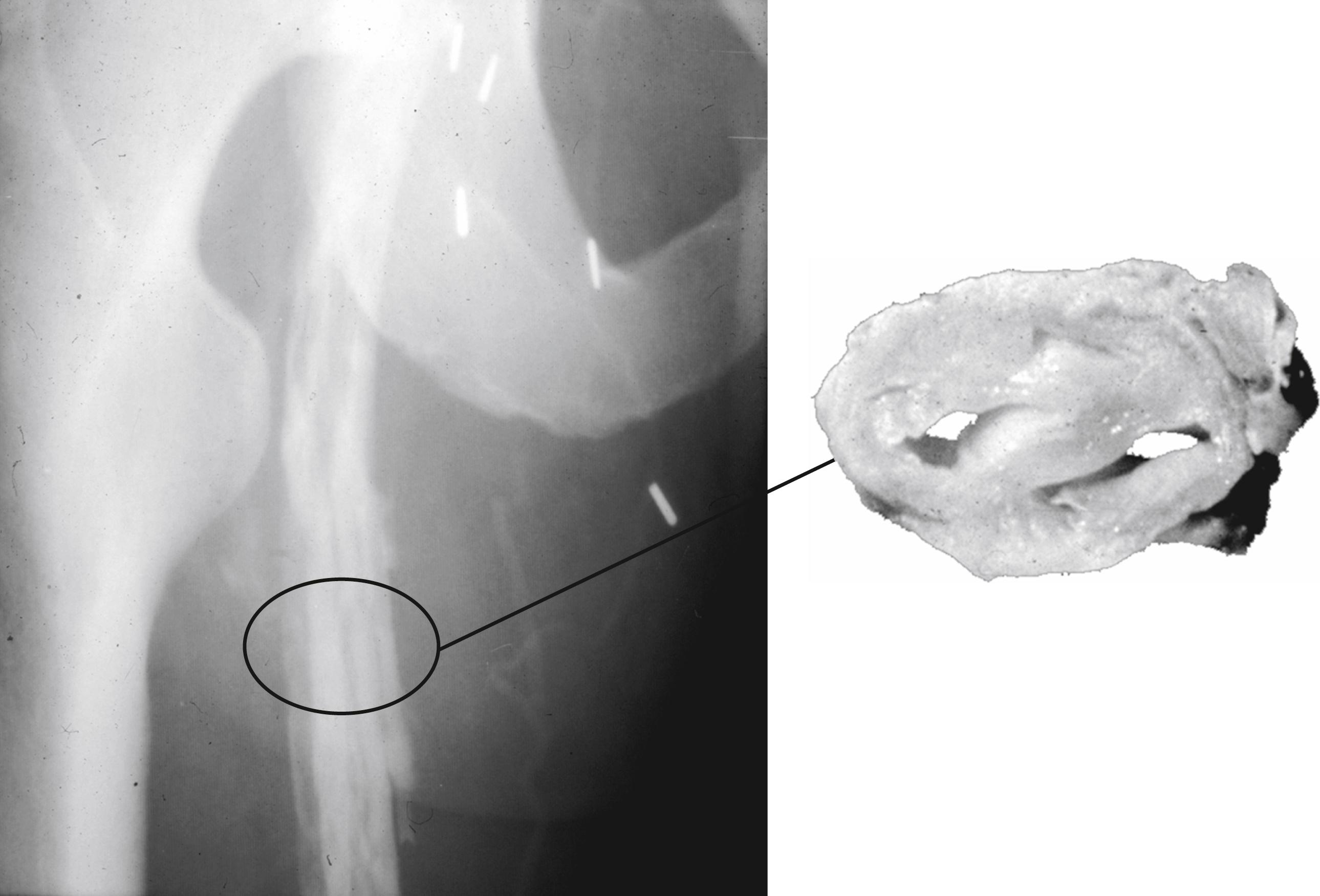 Figure 149.1, Post-thrombotic venous disease illustrating the inability to identify obstruction as part of the pathophysiology of chronic venous disease. This patient had had iliofemoral deep venous thrombosis 10 years earlier and was treated with anticoagulation alone. Severe post-thrombotic syndrome developed, and the patient underwent multiple hospitalizations for venous ulceration. An ascending phlebogram showed recanalization of the iliofemoral venous system; however, the radiologist’s interpretation was that there was “no obstruction” of the deep venous system, and a 3-second maximal venous outflow test was “normal.” A classic Linton procedure was performed and showed (inset) the cross-section of the femoral vein at the corresponding location on the phlebogram, just below the profunda femoris vein.