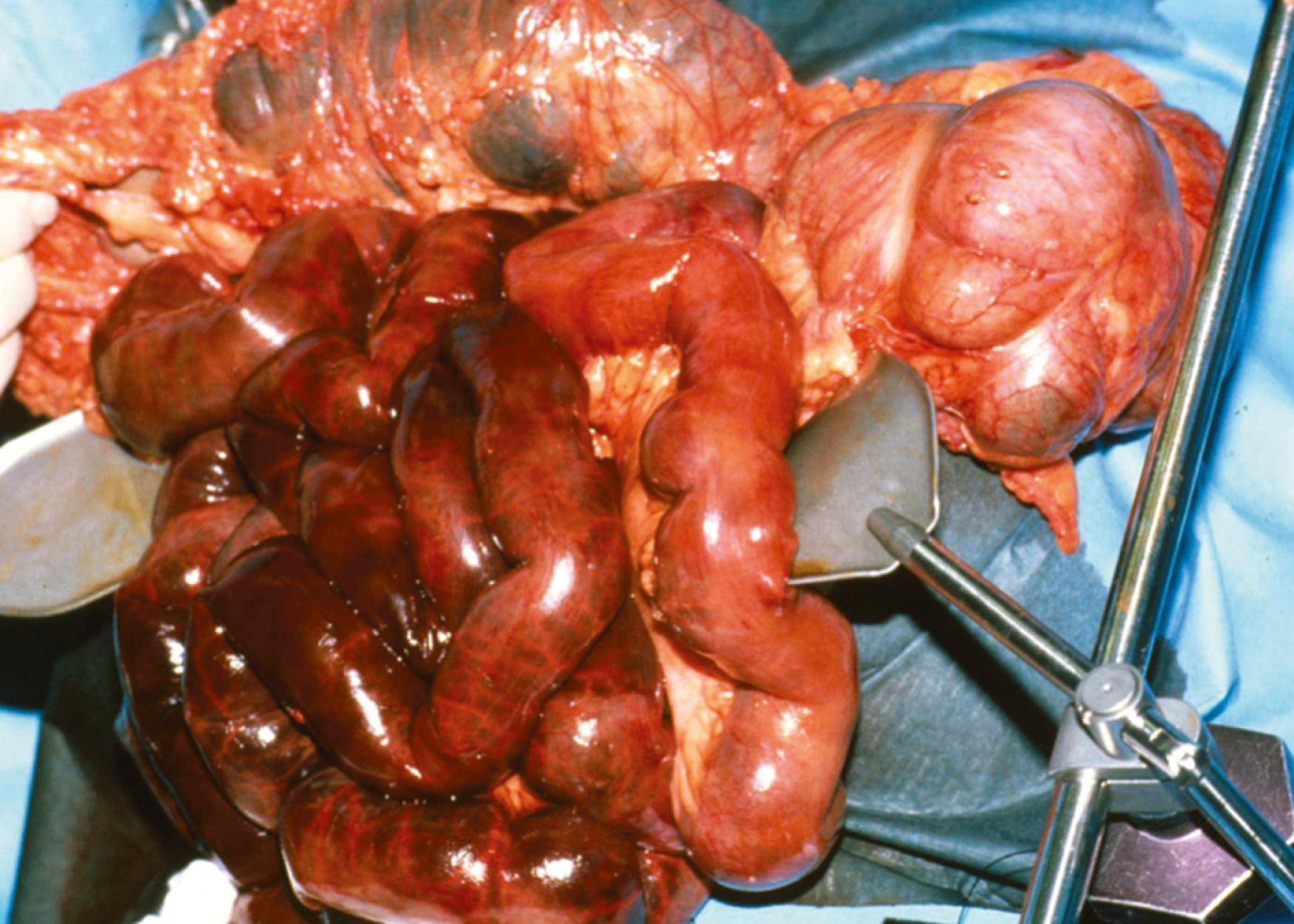 Figure 133.1, Intraoperative photograph of a patient with a superior mesenteric artery embolus. Note the relative sparing of the proximal jejunum and proximal transverse colon.