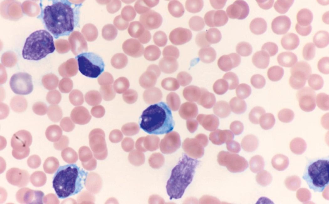 Fig. 8.11, Peripheral blood myeloid blasts.