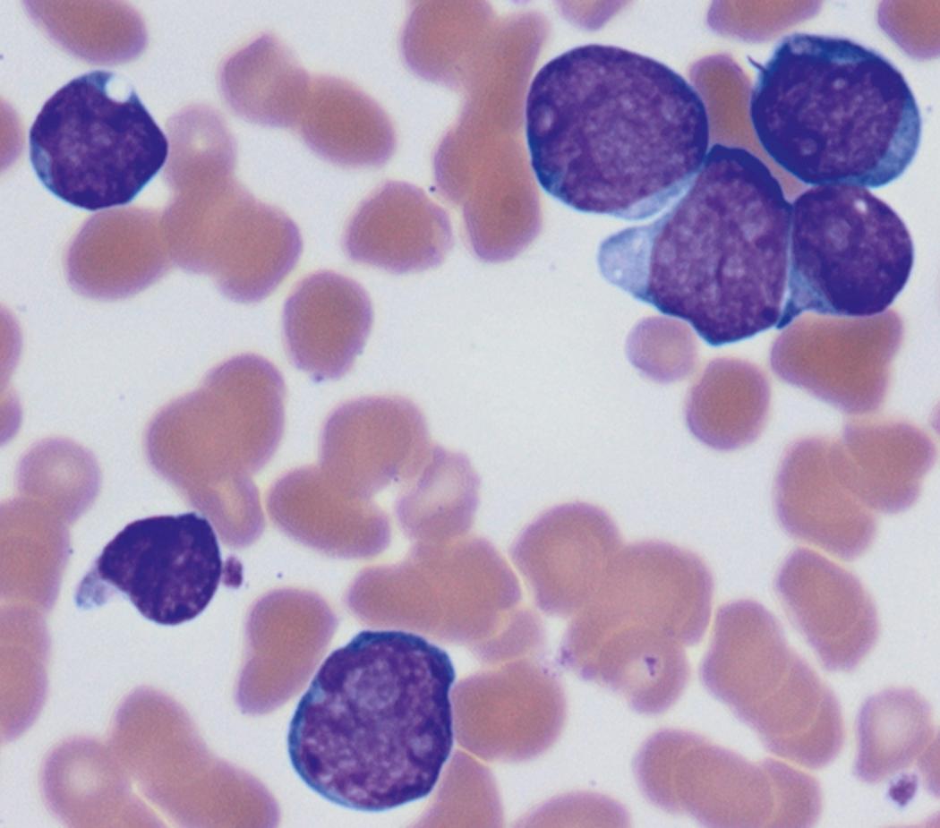 Fig. 8.12, Peripheral blood myeloid blasts.