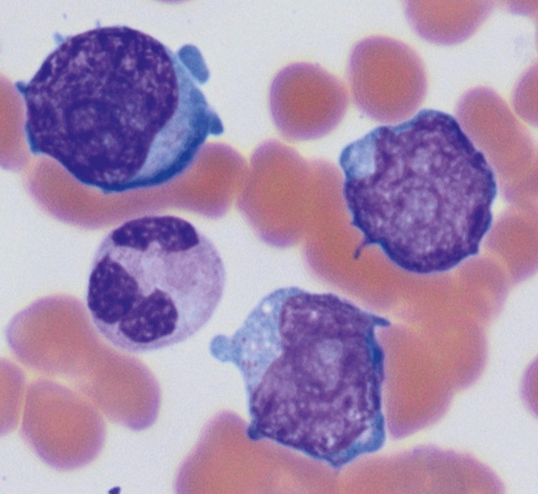 Fig. 8.13, Peripheral blood myeloid blasts.