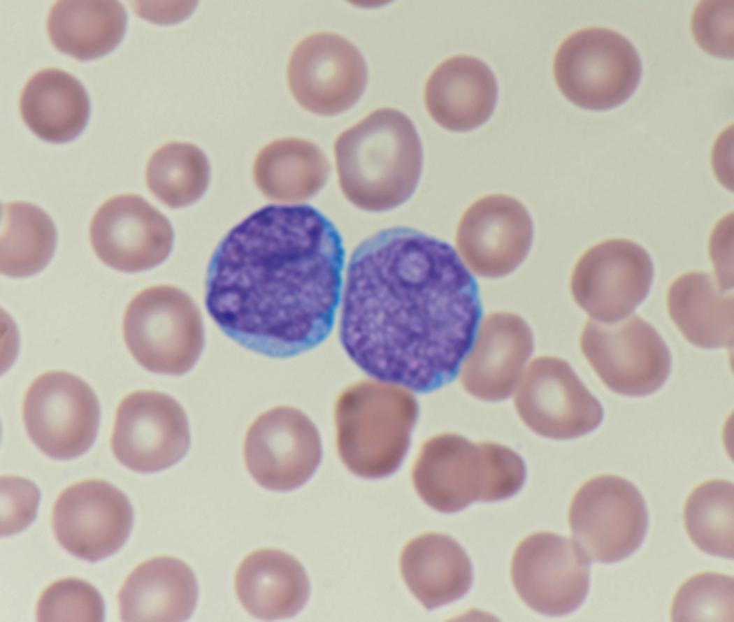 Fig. 8.14, Peripheral blood myeloid blasts.