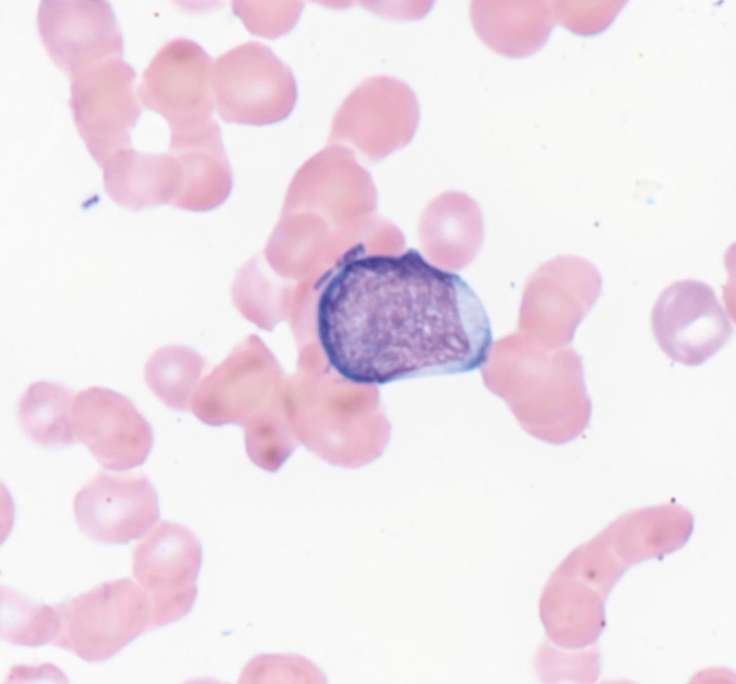 Fig. 8.15, Peripheral blood myeloid blast.