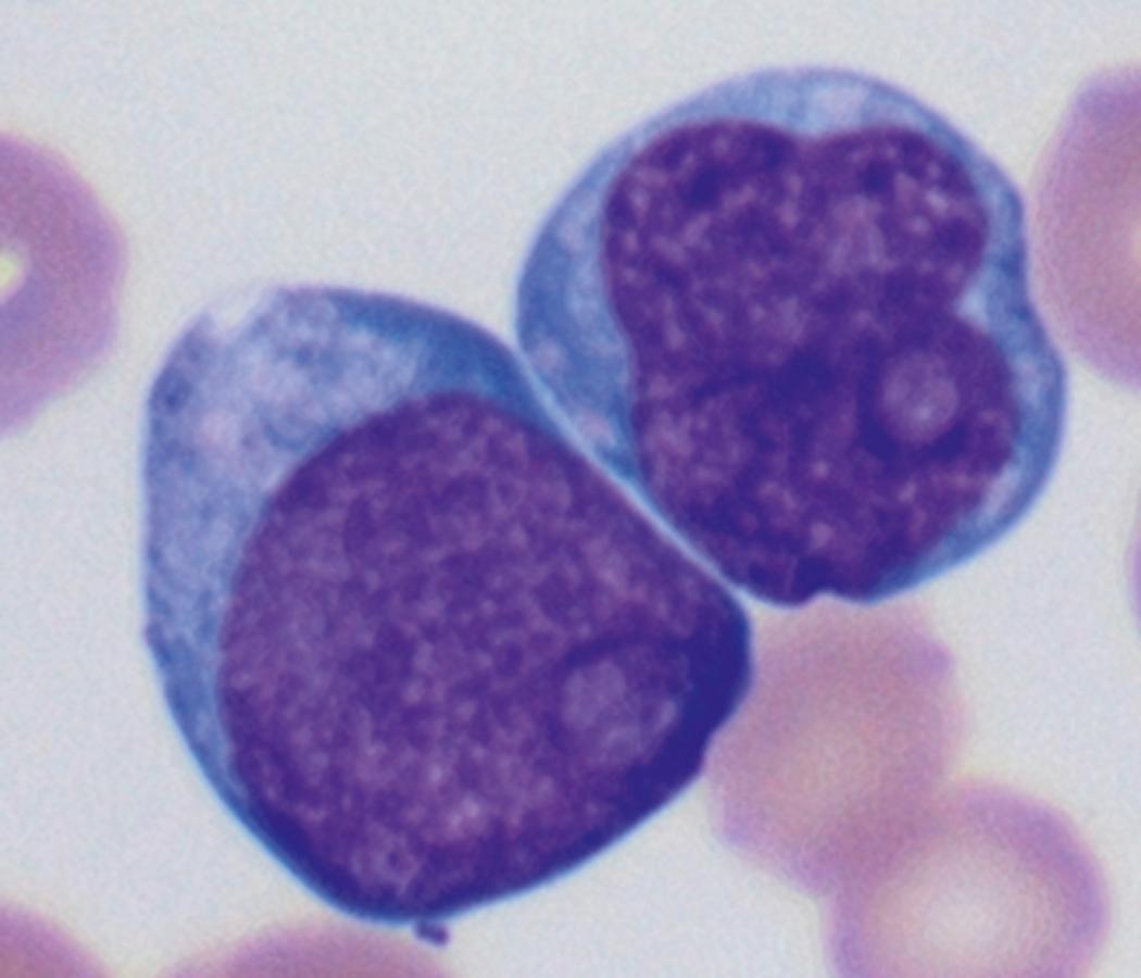 Fig. 8.16, Peripheral blood myeloid blasts.