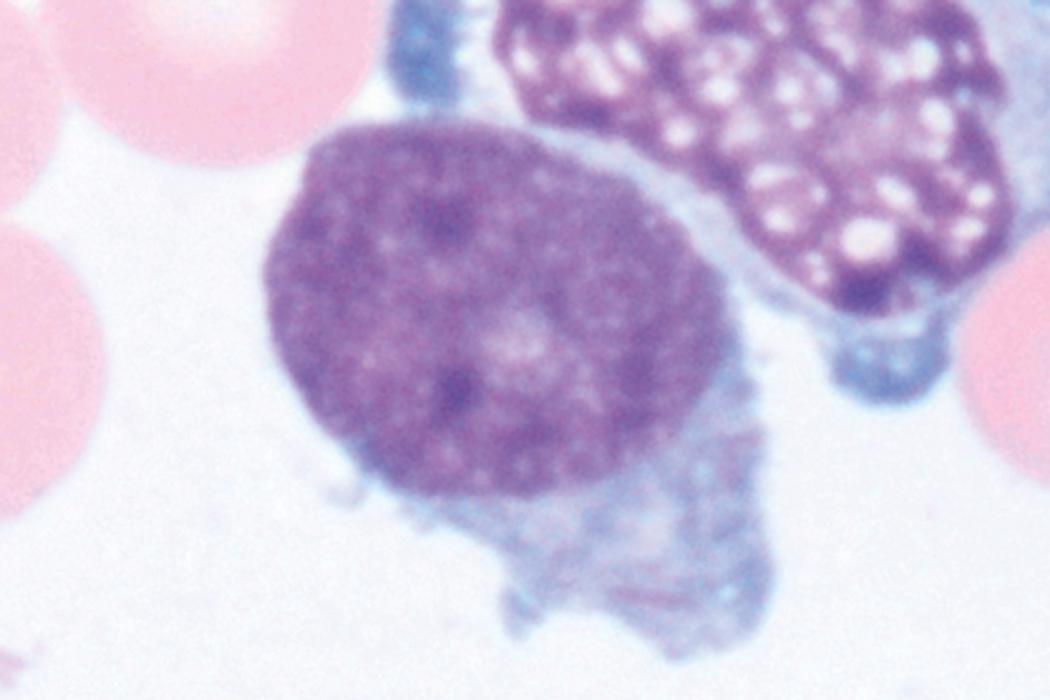 Fig. 8.17, Peripheral blood myeloid blast.