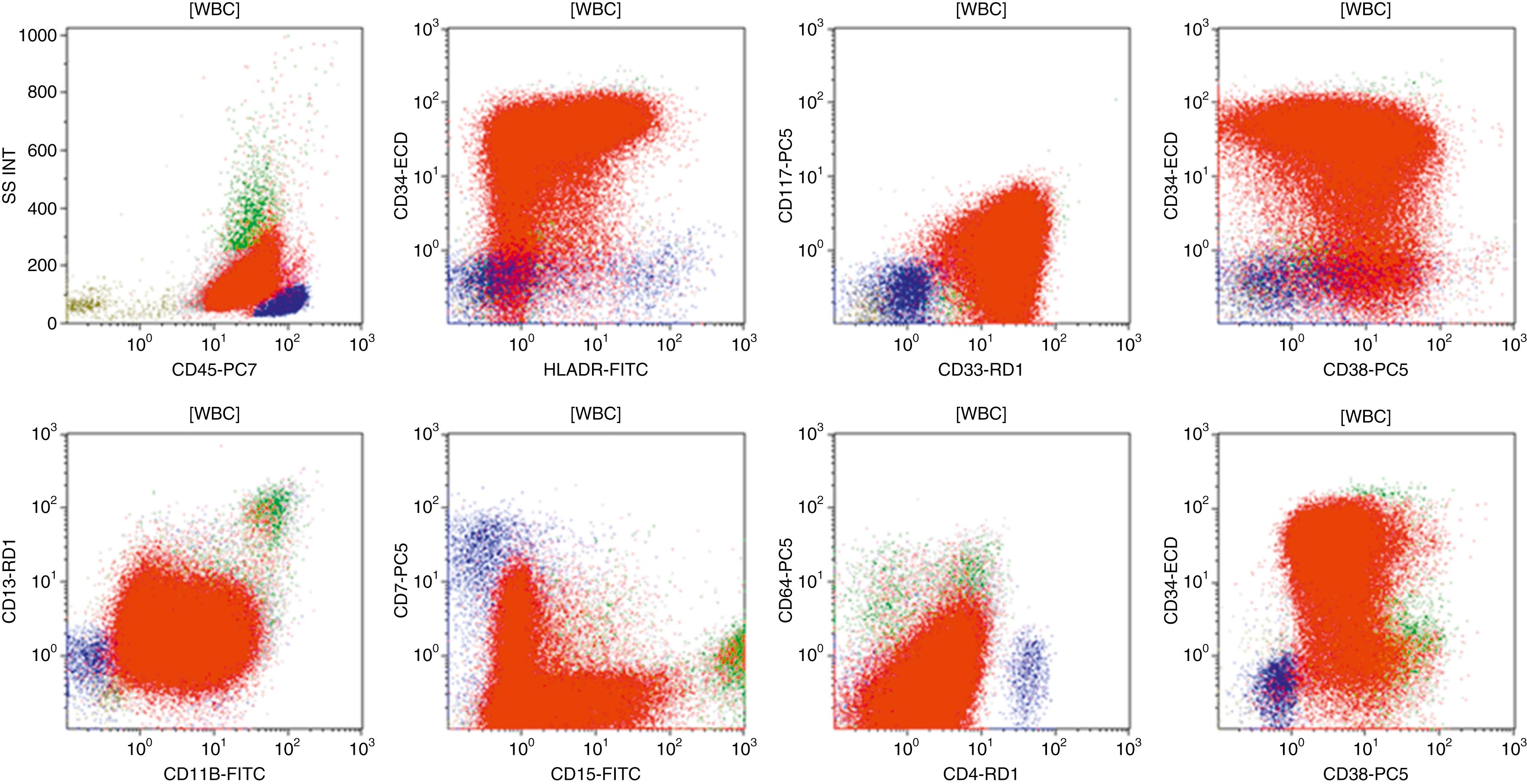 Fig. 8.18, Typical peripheral blood flow cytometry of a case of acute myeloid leukemia.