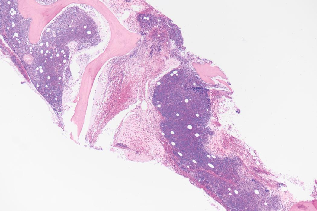 Fig. 8.19, Acute myeloid leukemia (AML) bone marrow core biopsy specimen.