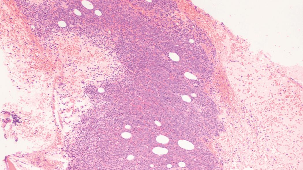 Fig. 8.20, Acute myeloid leukemia (AML) bone marrow core biopsy specimen.