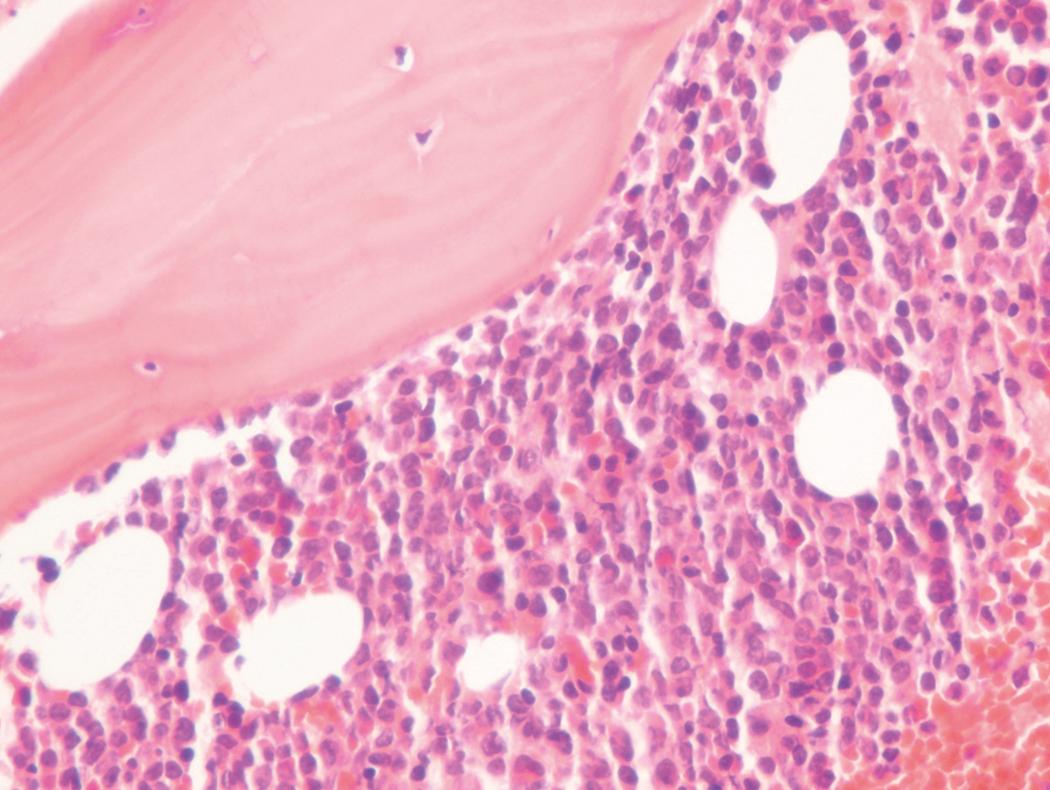Fig. 8.21, Acute myeloid leukemia bone marrow core biopsy specimen.