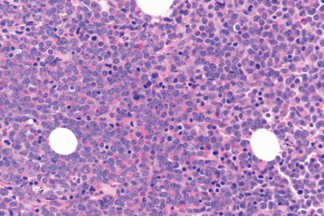 Fig. 8.22, Acute myeloid leukemia bone marrow core biopsy specimen.