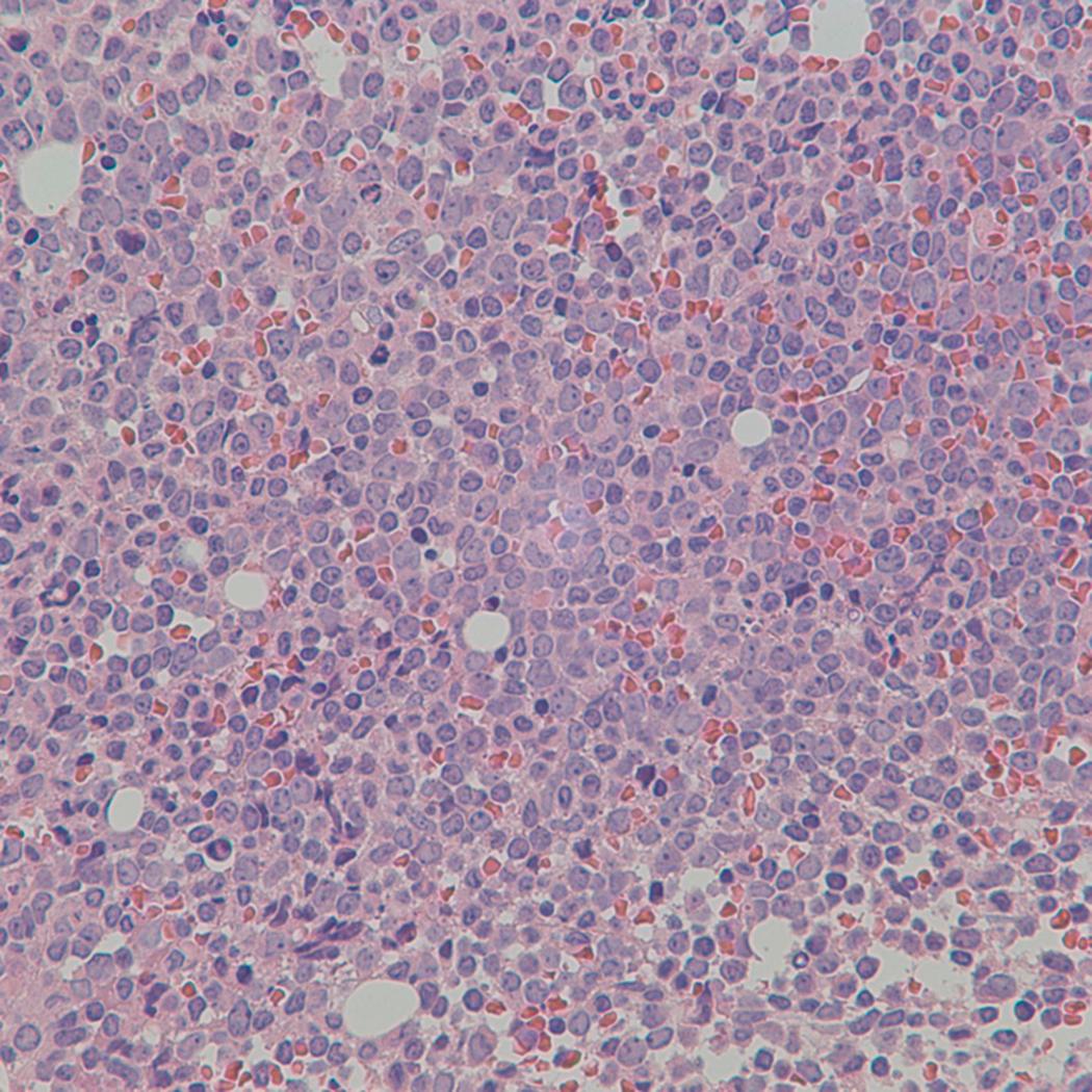 Fig. 8.23, Acute myeloid leukemia bone marrow core biopsy specimen.