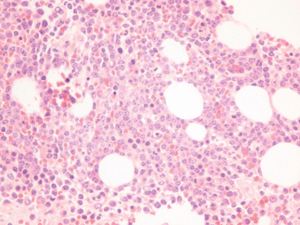 Fig. 8.24, Acute myeloid leukemia bone marrow core biopsy specimen.