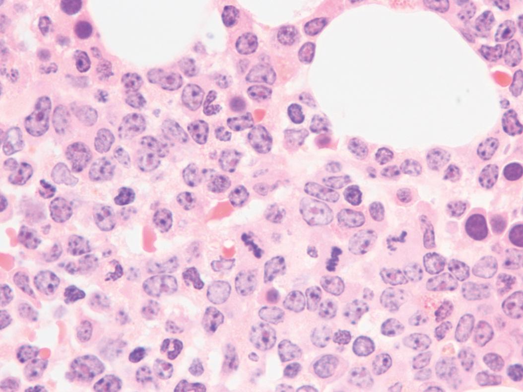 Fig. 8.25, Acute myeloid leukemia bone marrow core biopsy specimen.