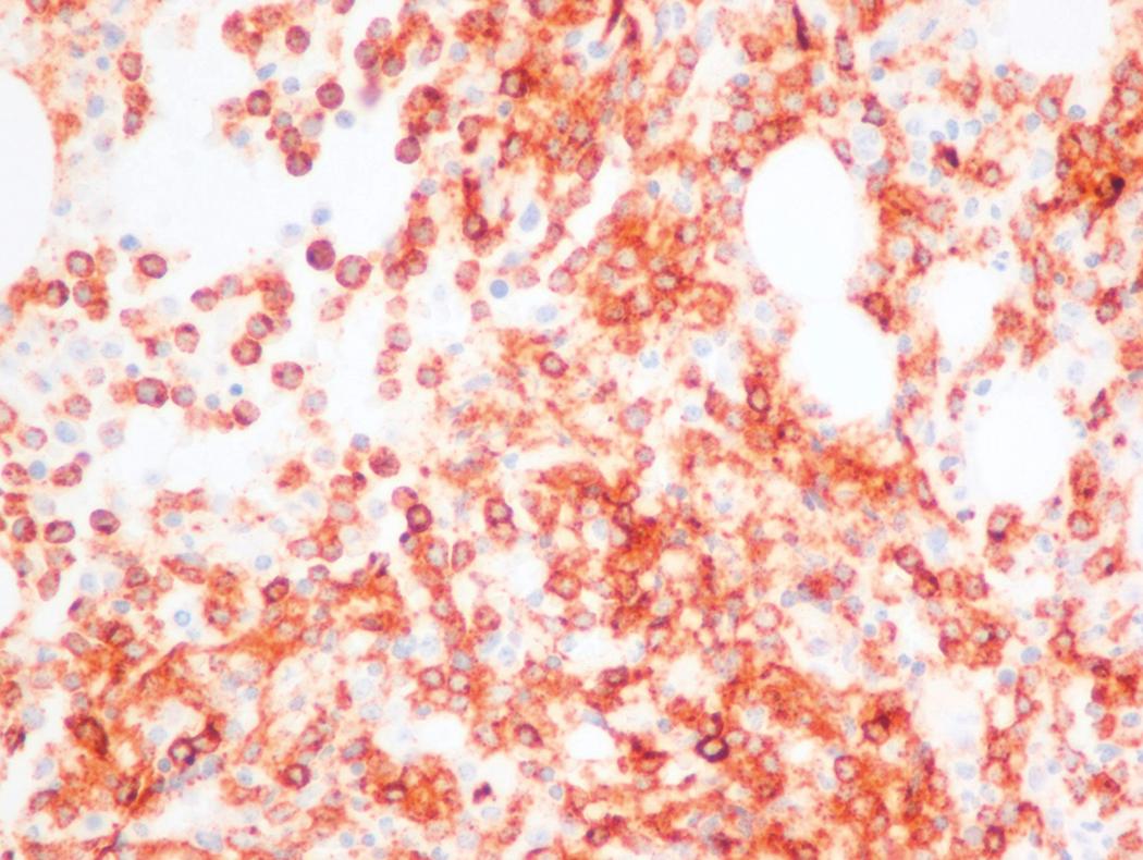 Fig. 8.26, Acute myeloid leukemia (AML) bone marrow core biopsy specimen stained for CD34.