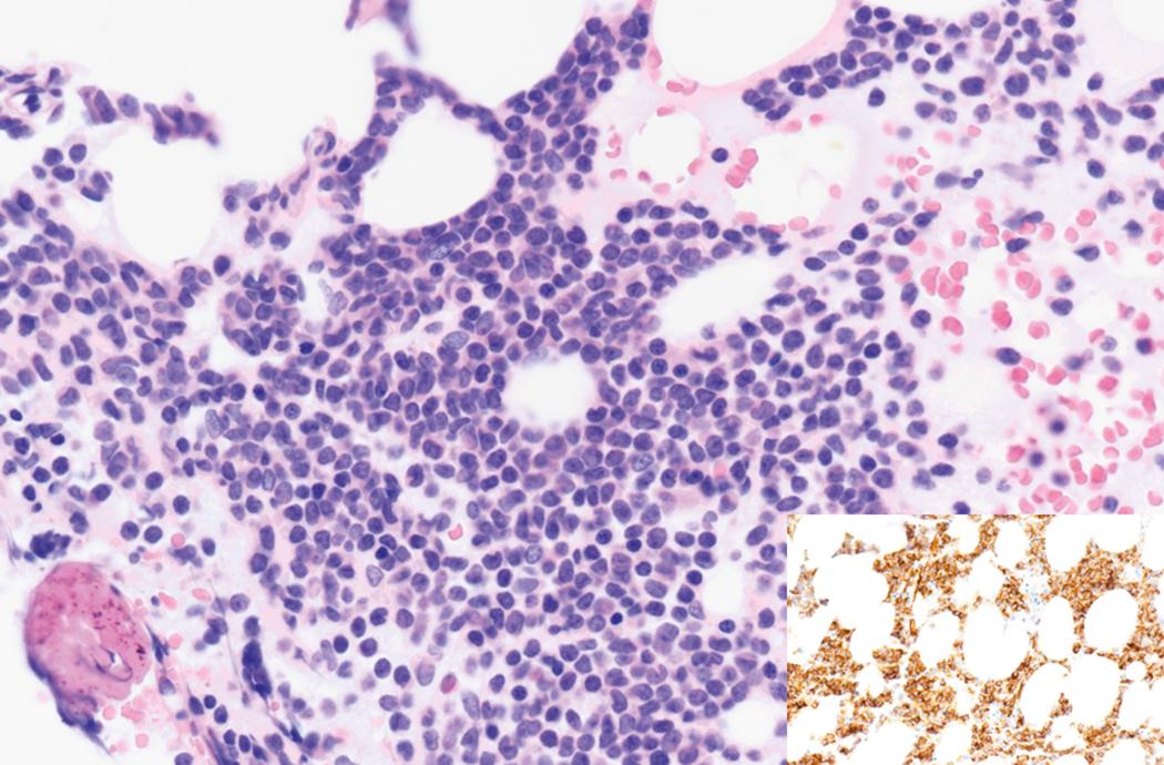 Fig. 8.27, Acute myeloid leukemia bone marrow core biopsy specimen.