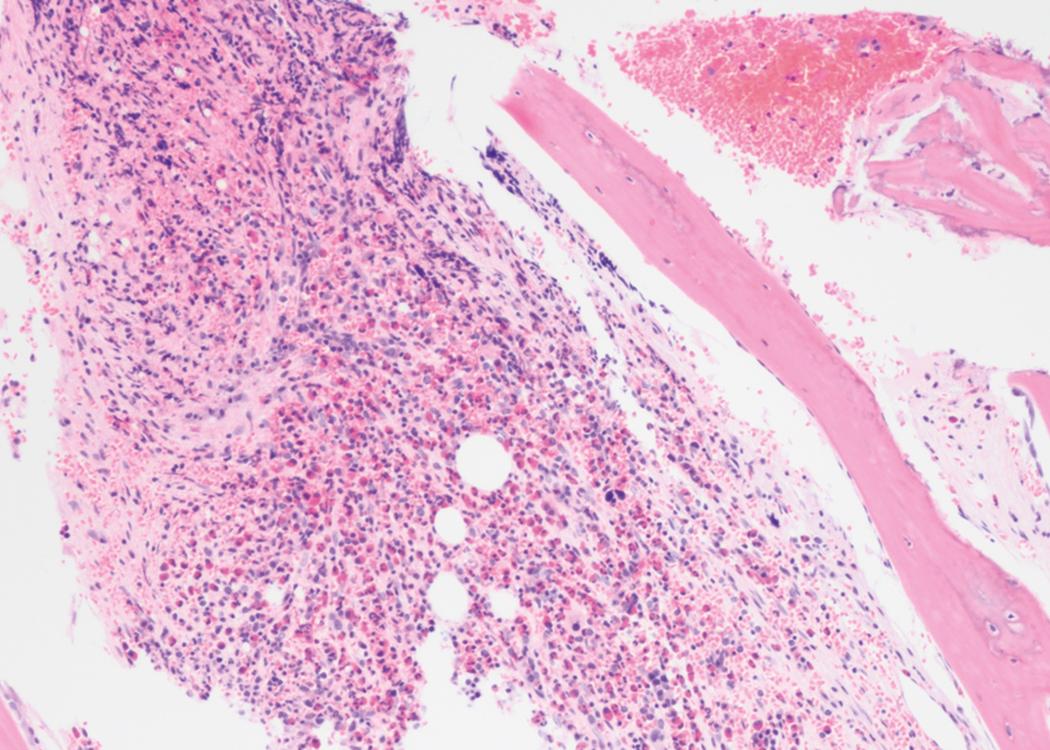 Fig. 8.28, Acute myeloid leukemia (AML) bone marrow core biopsy specimen.