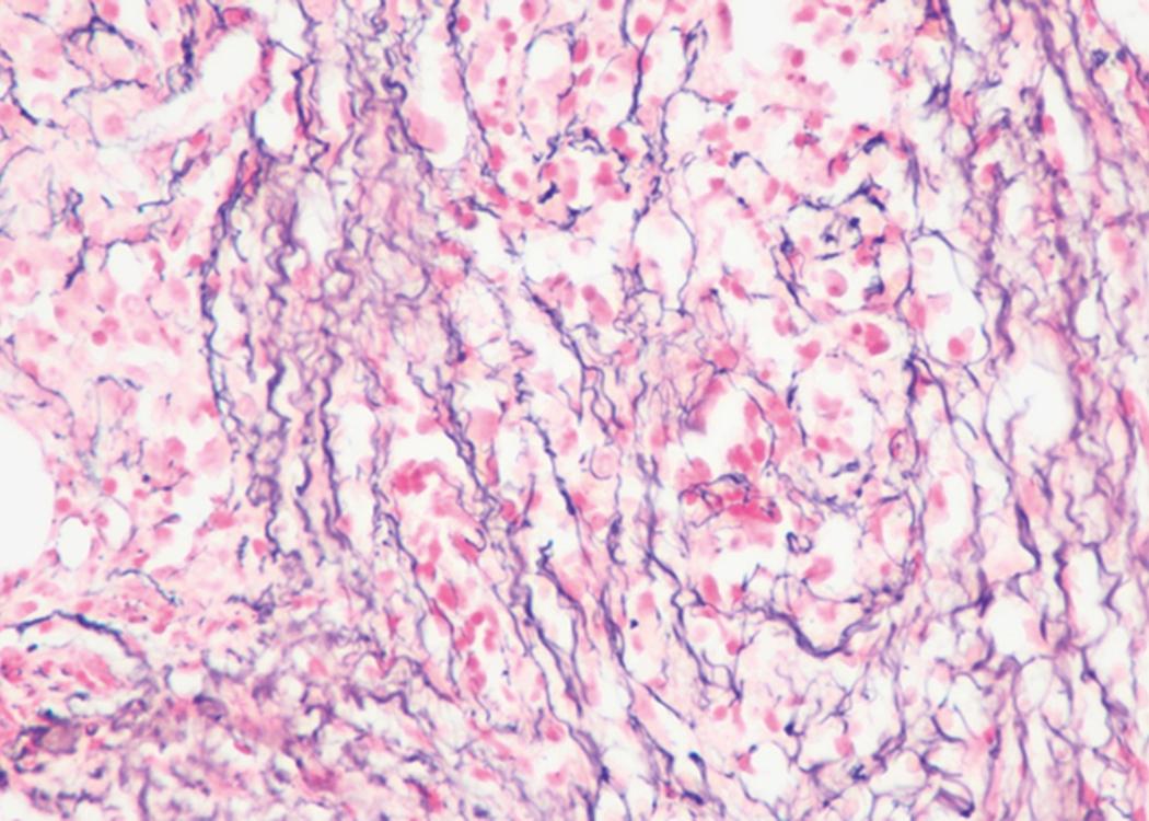 Fig. 8.29, Acute myeloid leukemia (AML).