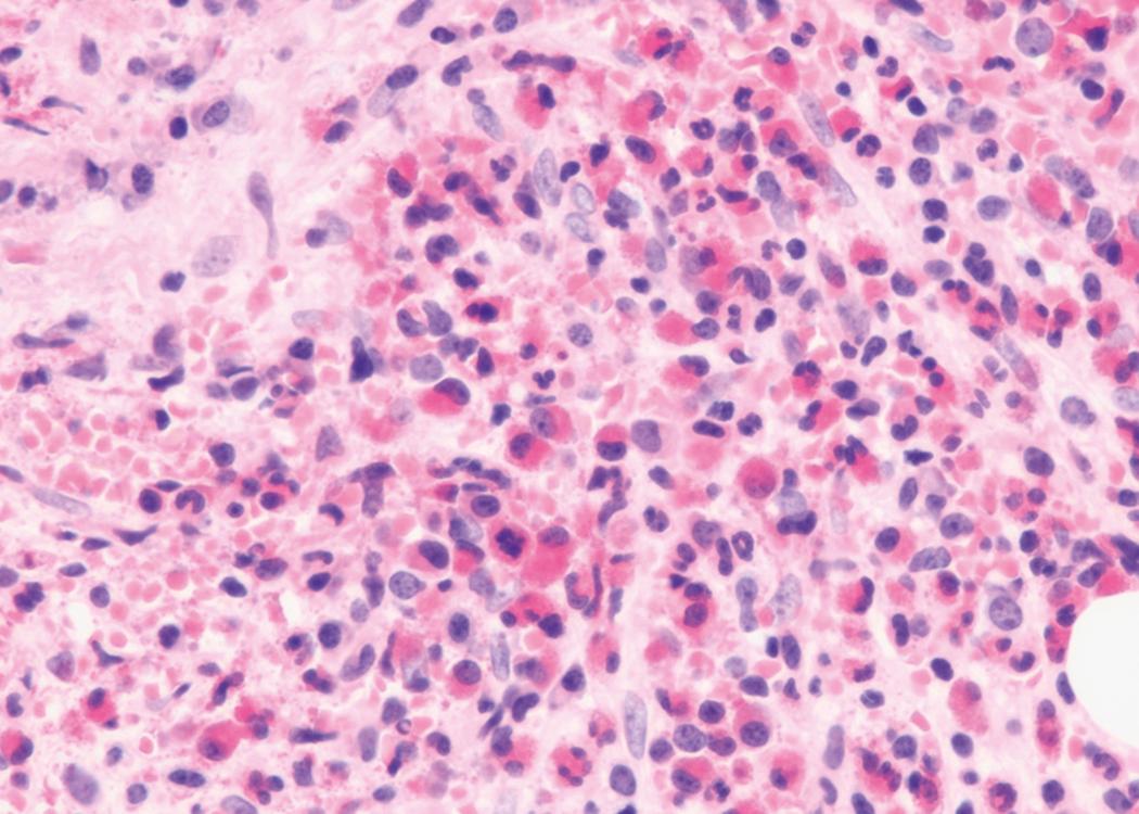 Fig. 8.30, Acute myeloid leukemia (AML) bone marrow core biopsy specimen.