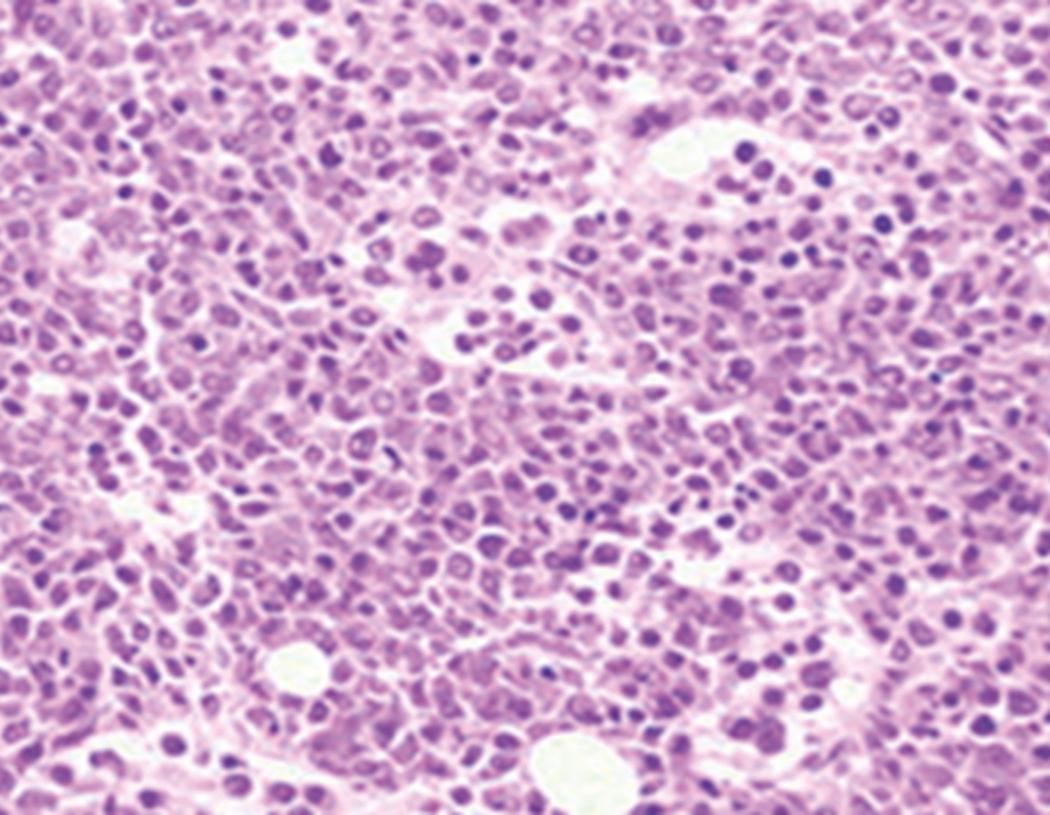 Fig. 8.31, Acute myeloid leukemia (AML) bone marrow core biopsy specimen.