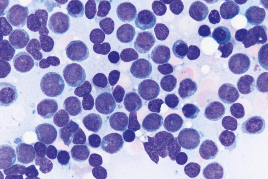 Fig. 8.32, Acute myeloid leukemia bone marrow aspirate.