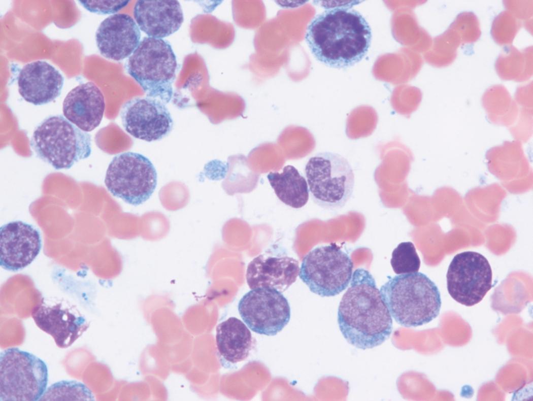Fig. 8.35, Acute myeloid leukemia bone marrow aspirate.