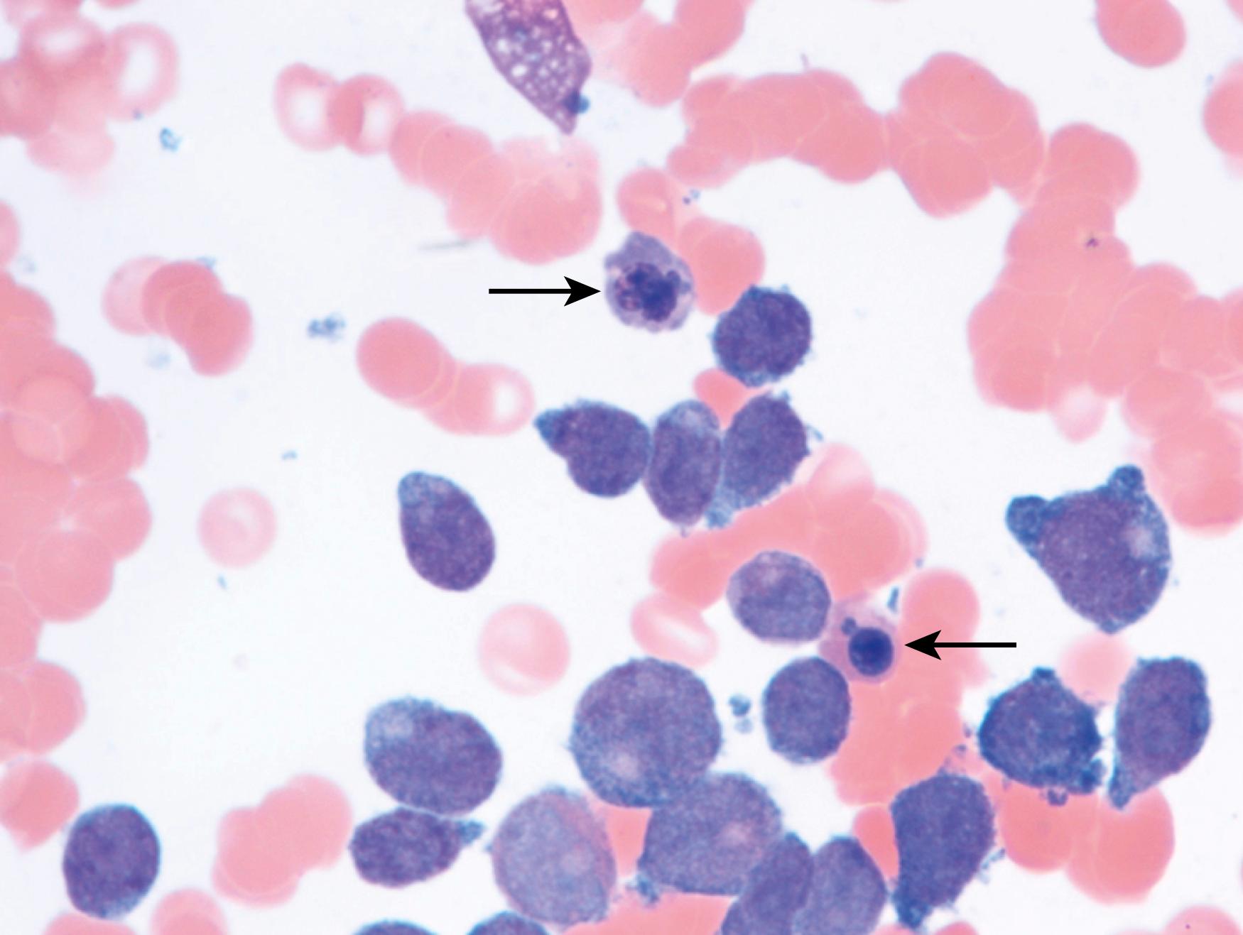 Fig. 8.36, Acute myeloid leukemia (AML) bone marrow aspirate.