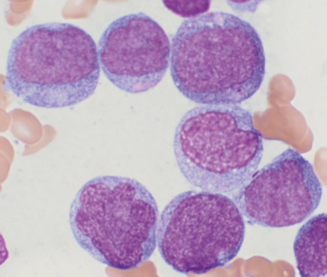 Fig. 8.37, Acute myeloid leukemia AML bone marrow aspirate.