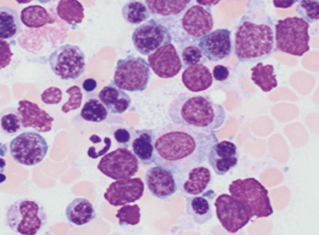 Fig. 8.38, Acute myeloid leukemia (AML) bone marrow aspirate.