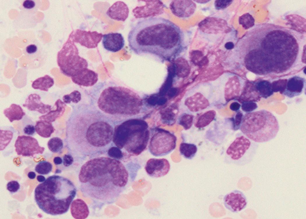 Fig. 8.39, Acute myeloid leukemia (AML) bone marrow aspirate.