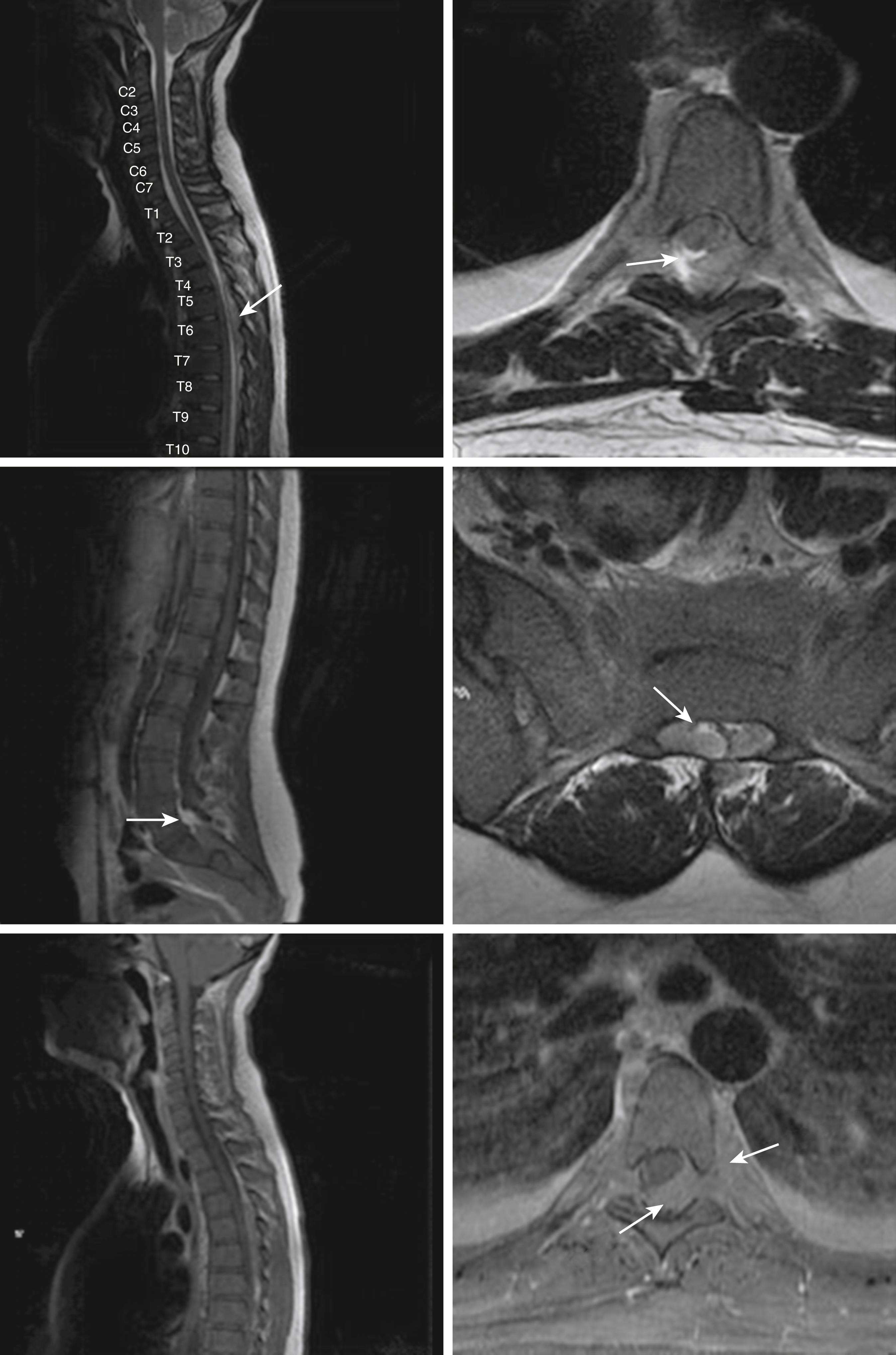 Fig. 8.3, Chloroma (or myeloid sarcoma) of the central nervous system (CNS).