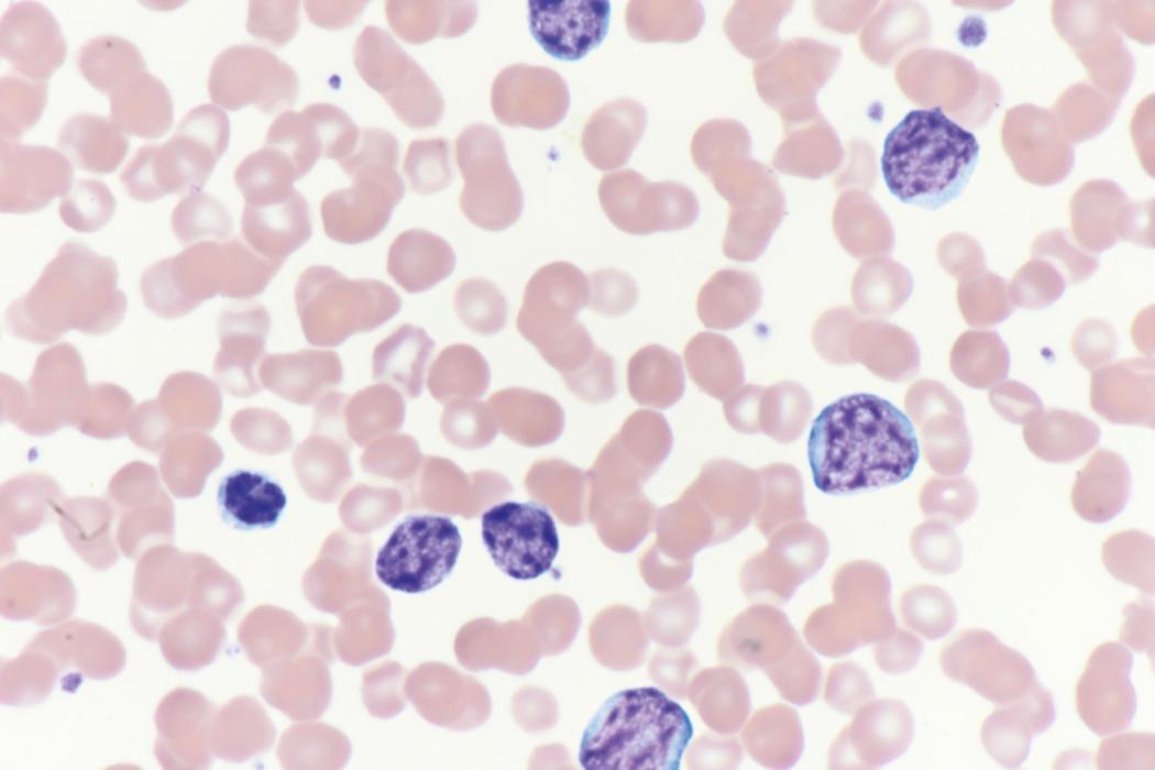 Fig. 8.7, Peripheral blood myeloid blasts.