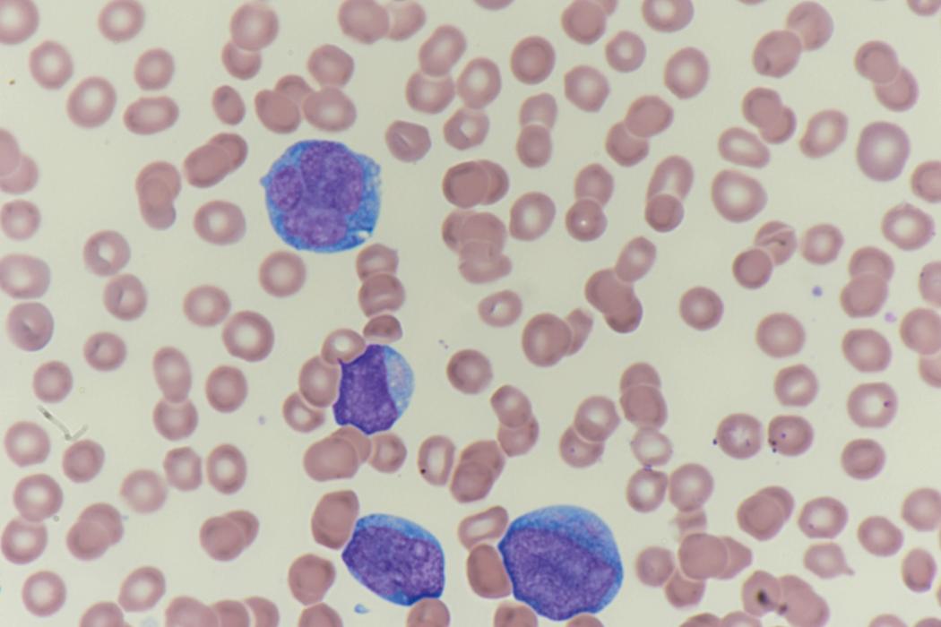 Fig. 8.9, Peripheral blood myeloid blasts.