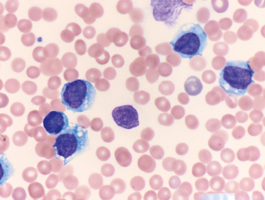Fig. 8.10, Peripheral blood myeloid blasts.