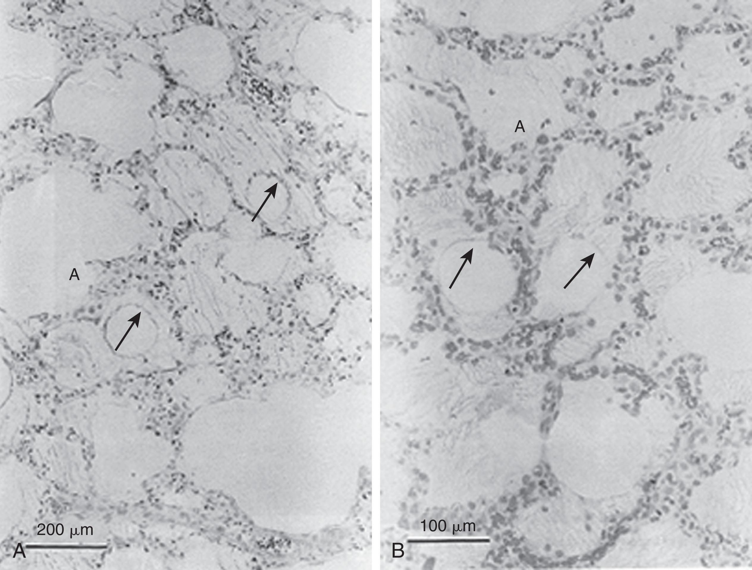 Fig. 42.2, Low power (A) and higher power (B) photomicrographs of lung tissue from an experimental animal with respiratory distress syndrome, flash frozen during inflation. Note the liquid–air interface (arrows). The alveolar debris forms hyaline membranes.