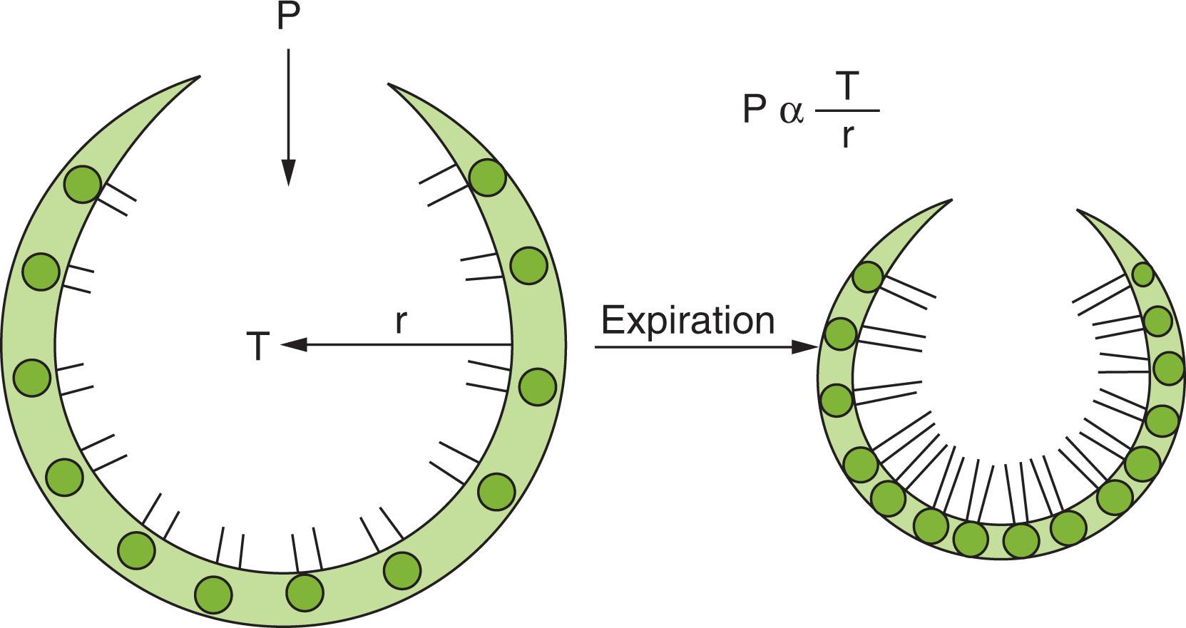 Fig. 42.4, Surfactant Molecules on Surface Crowding During Deflation. Less pressure (P) is needed to overcome the surface tension (T) as the radius (r) decreases due to surfactant crowding during deflation.