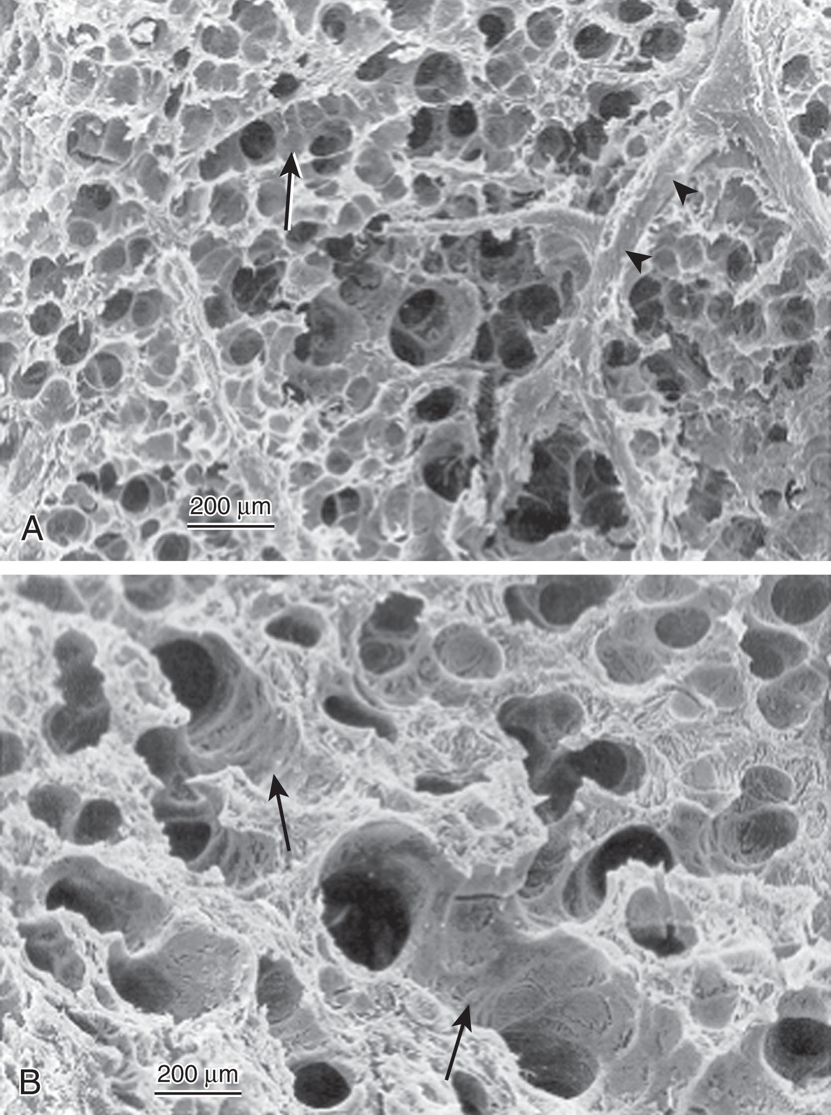 Fig. 42.6, Histology of Respiratory Distress Syndrome. Scanning electron micrograph of lung frozen during inflation with air in a healthy premature monkey (A) compared with one with respiratory distress syndrome (B). Lungs affected by respiratory distress syndrome have collapsed alveoli full of liquid and proteinaceous debris, with overdistended terminal airways.