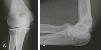 FIGURE 11–1, A and B , Anteroposterior and lateral radiographs of the elbow show normal anterior fat pad.