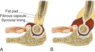 FIGURE 11–2, The fat pads of the elbow without ( A ) and with ( B ) joint distention.