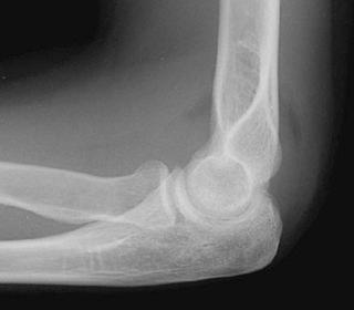 FIGURE 11–3, Lateral radiograph of the elbow reveals displacement of both anterior and posterior fat pads.