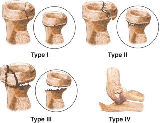 FIGURE 11–4, Mason classification of radial head/neck fractures.