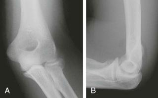 FIGURE 11–5, A and B , Anteroposterior and lateral radiographs of the elbow reveal displacement of the anterior and posterior fat pads, with cortical step-off at the lateral aspect of the head/neck junction: Mason type I fracture.