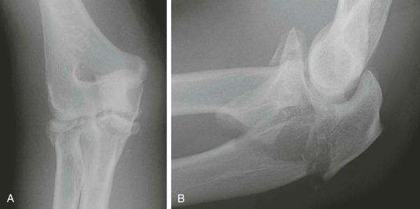 FIGURE 11–6, A and B , Anteroposterior and lateral radiographs of the elbow reveal a complex fracture with comminution of the radial head and proximal ulna with diastasis.