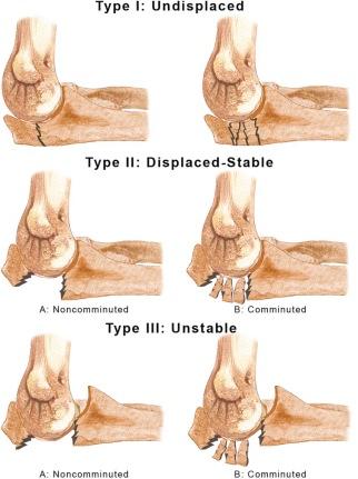 FIGURE 11–7, The Mayo classification system for olecranon fractures.